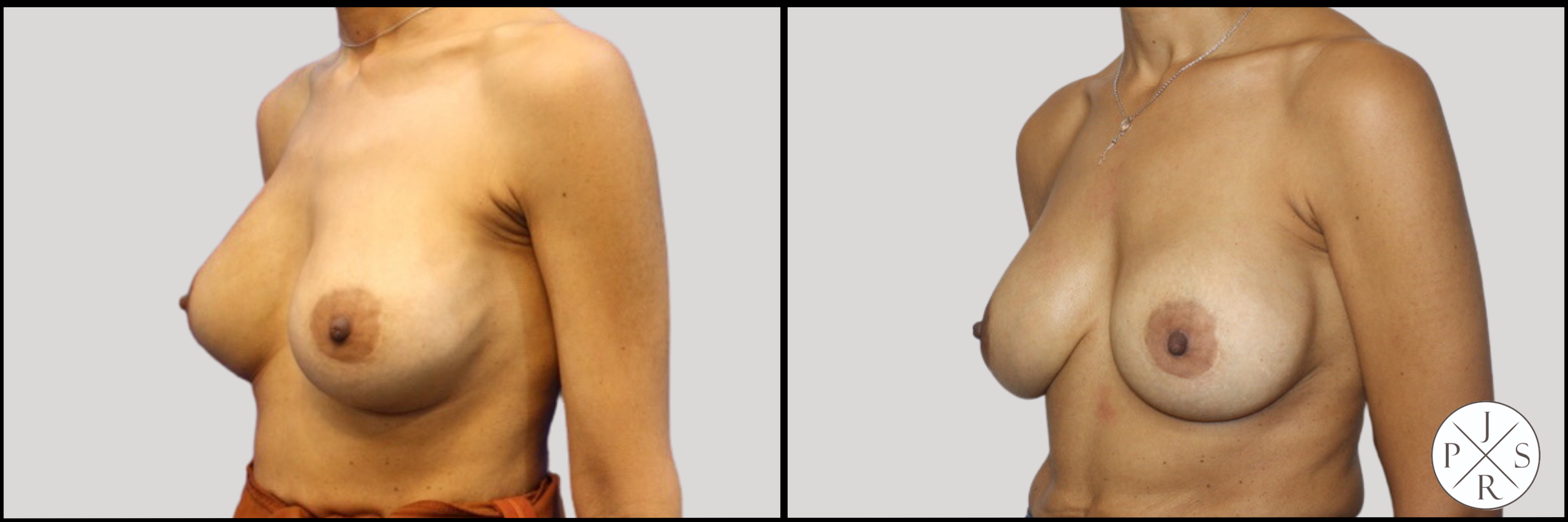 Breast Revision Before & After Image